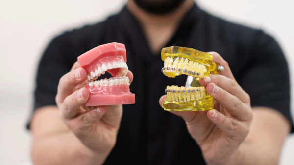 Types of dental braces: differences and characteristics