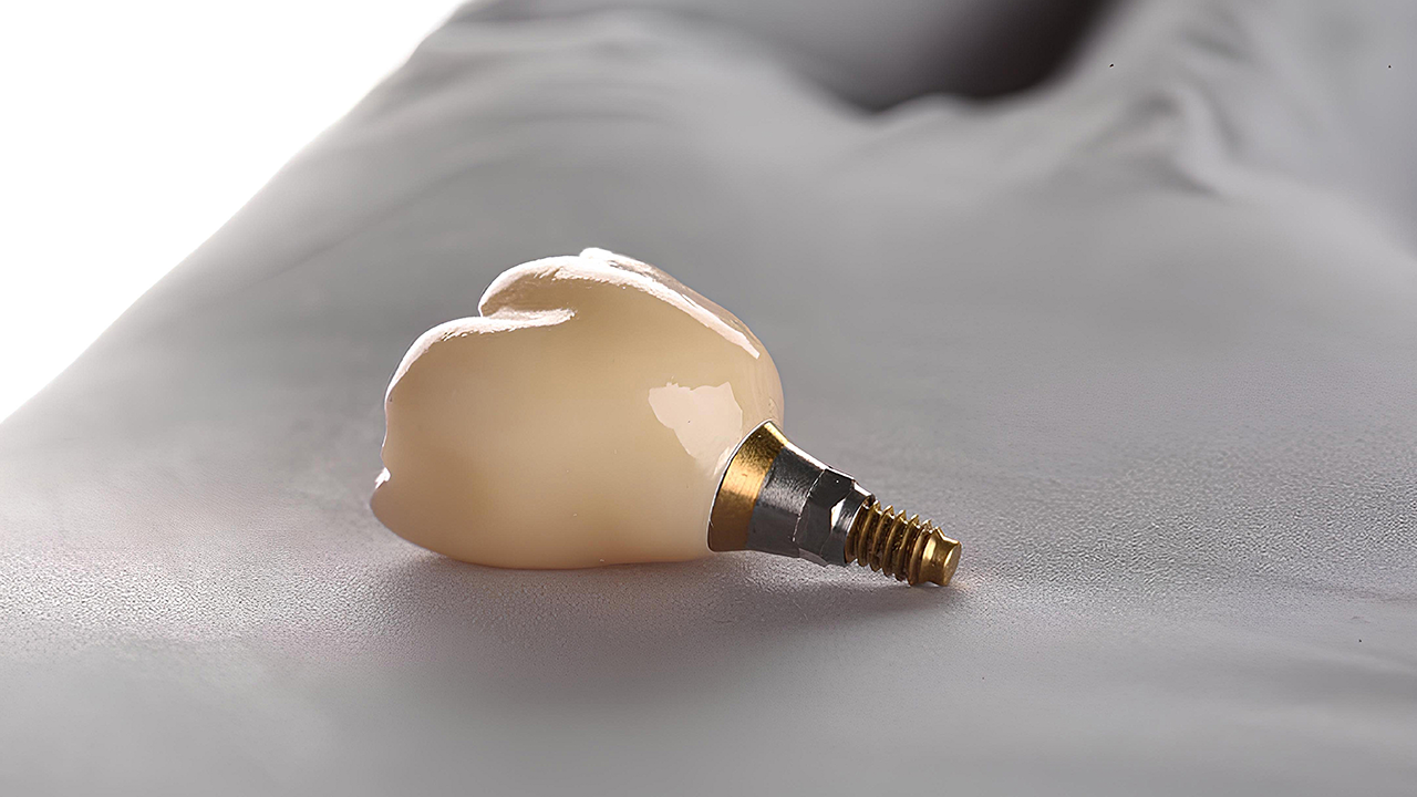 Implant dentaire: récupération et soins postopératoires