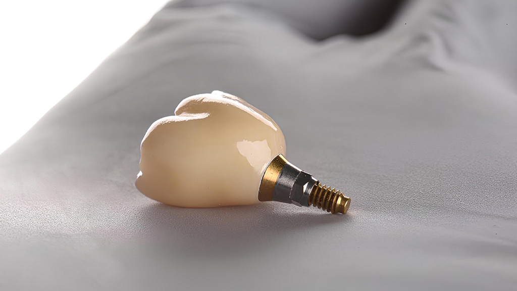 Dental Implant: Recovery and Post-Surgery Care
