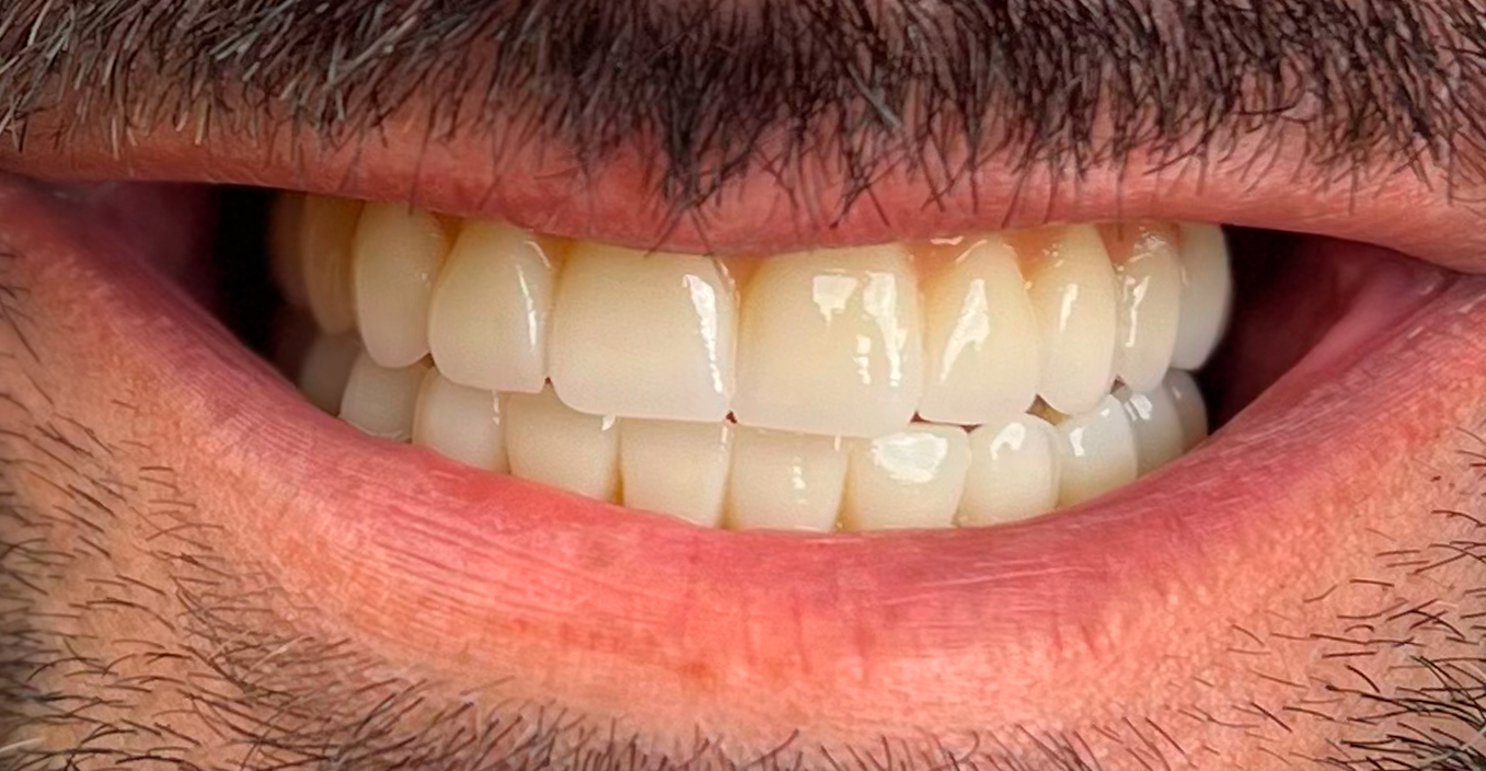 Antes