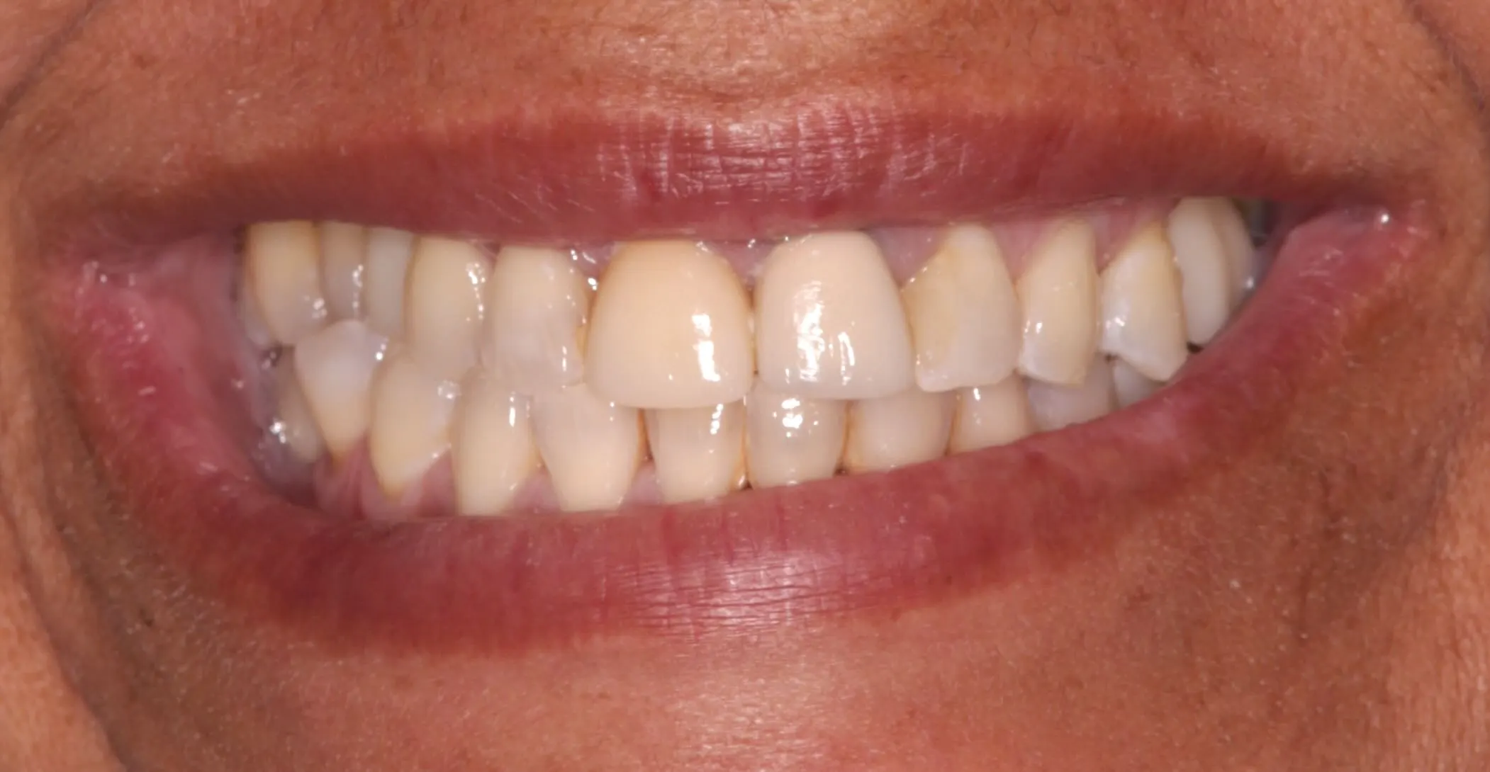 Antes