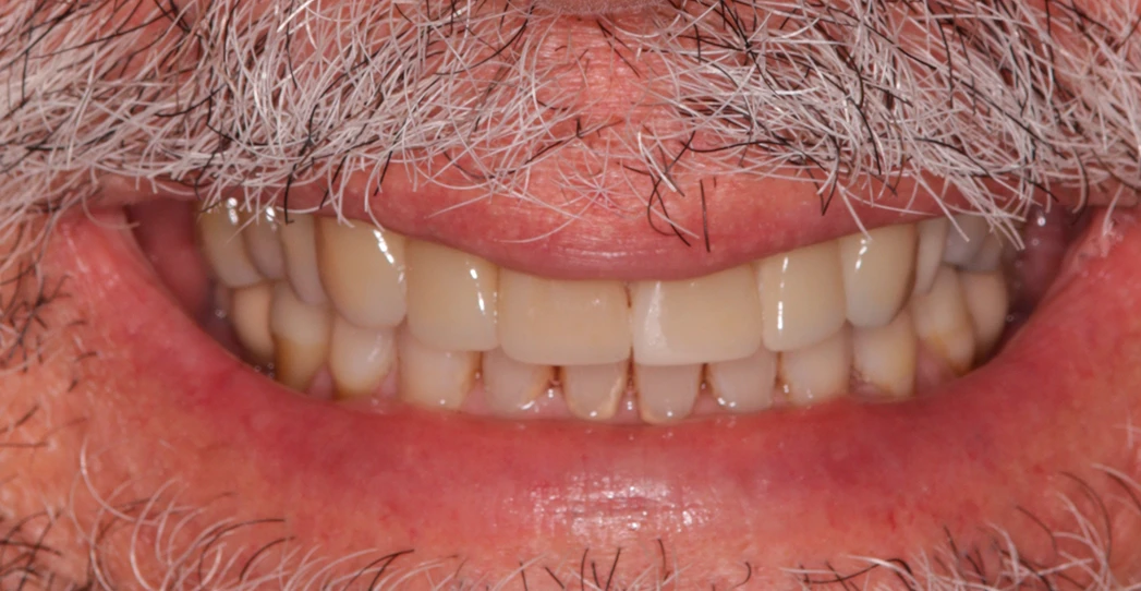 Antes